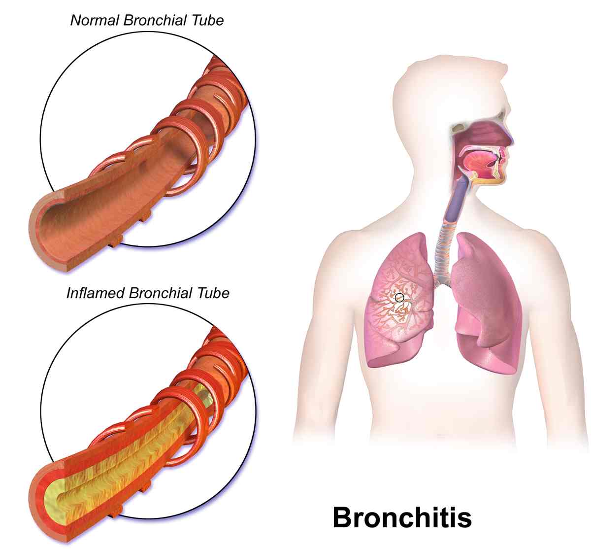 Treatment of Allergic Bronchitis